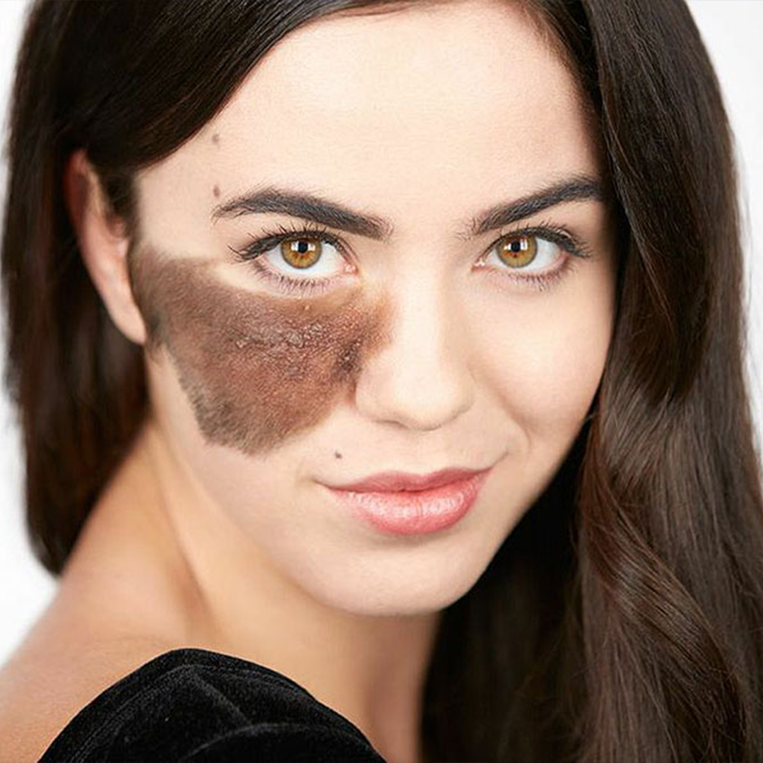 Cassandra naud hairy birthmark