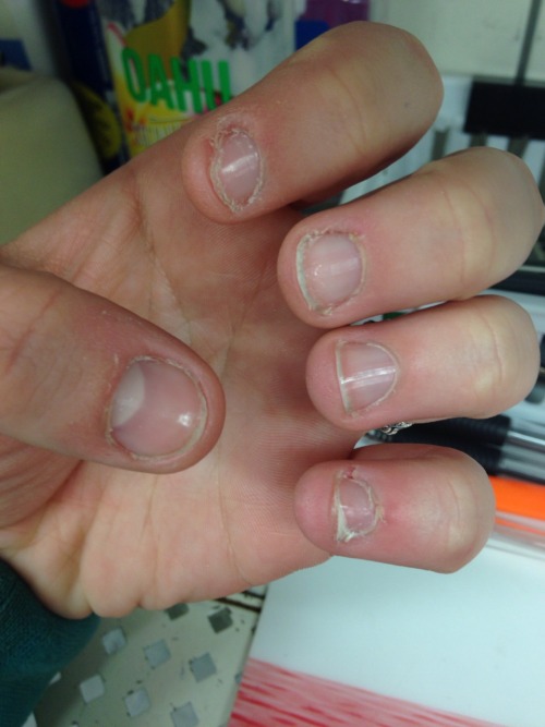 Biting nails