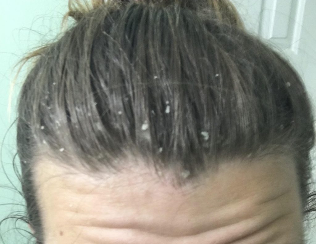dandruff