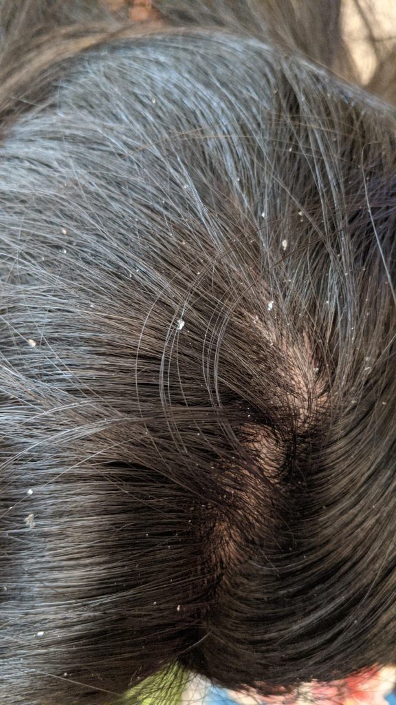 dandruff