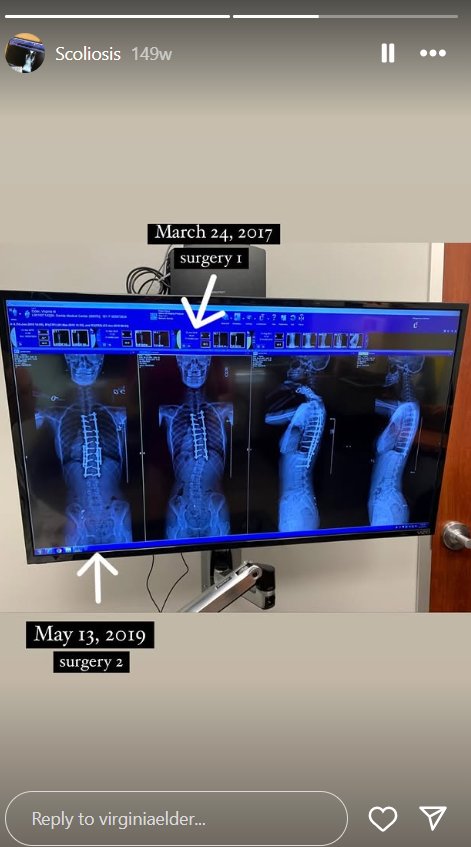 Two major spinal surgeries — in 2017 and 2019 — helped Virginia Elder stabilize her scoliosis with extensive hardware. | Source: Instagram/virginiaelder