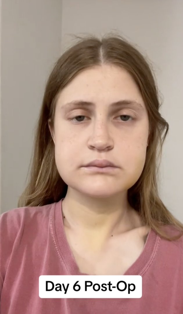 Virginia Elder documents Day 6 post-op with a still and centered selfie. | Source: TikTok/virginiaeelder