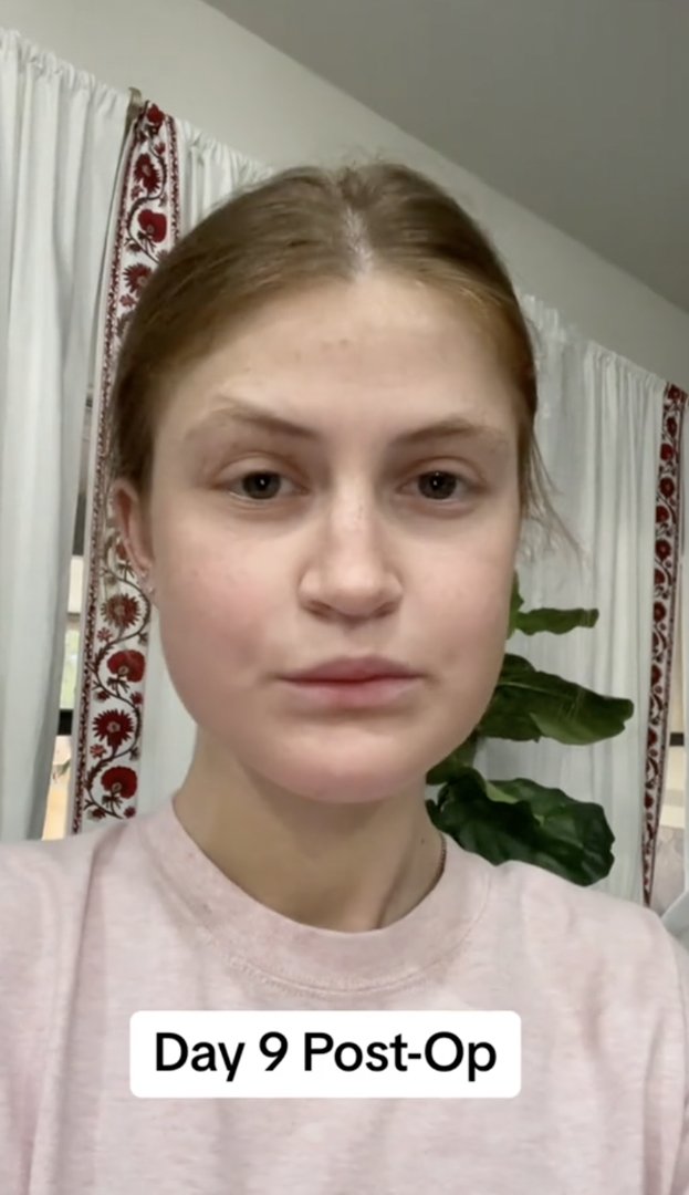 Virginia Elder posts a forward-facing photo on Day 9 with subtle healing progress. | Source: TikTok/virginiaeelder