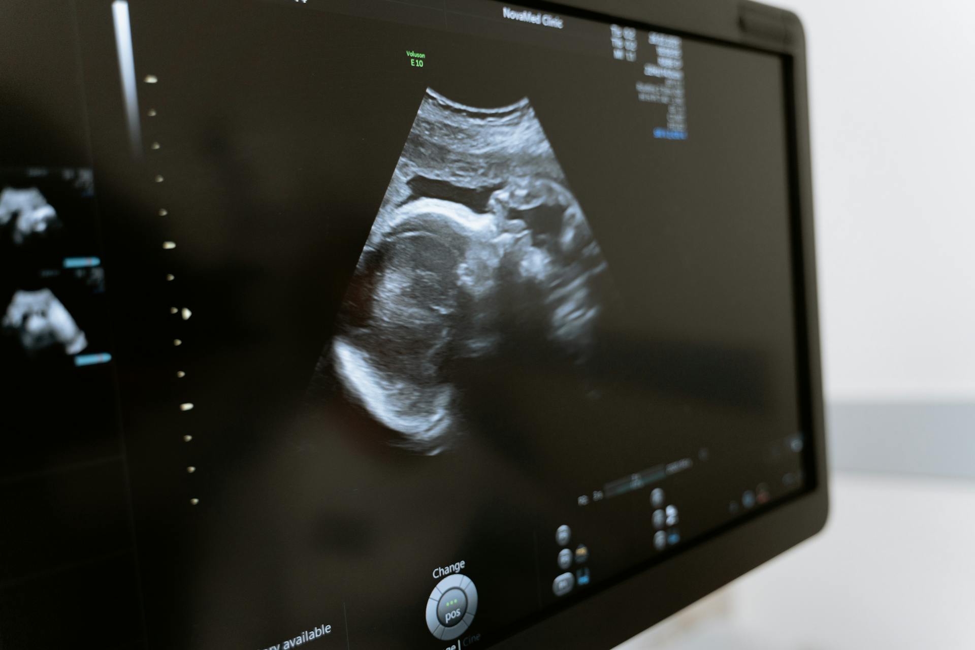 An ultrasound scan on a computer screen | Source: Pexels