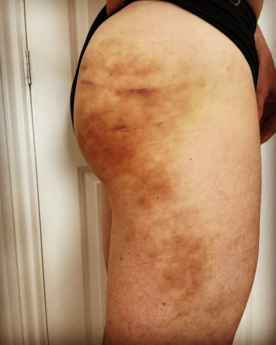 Fred Sirieix poses with his bruises on full display. | Source: Instagram/fred_sirieix