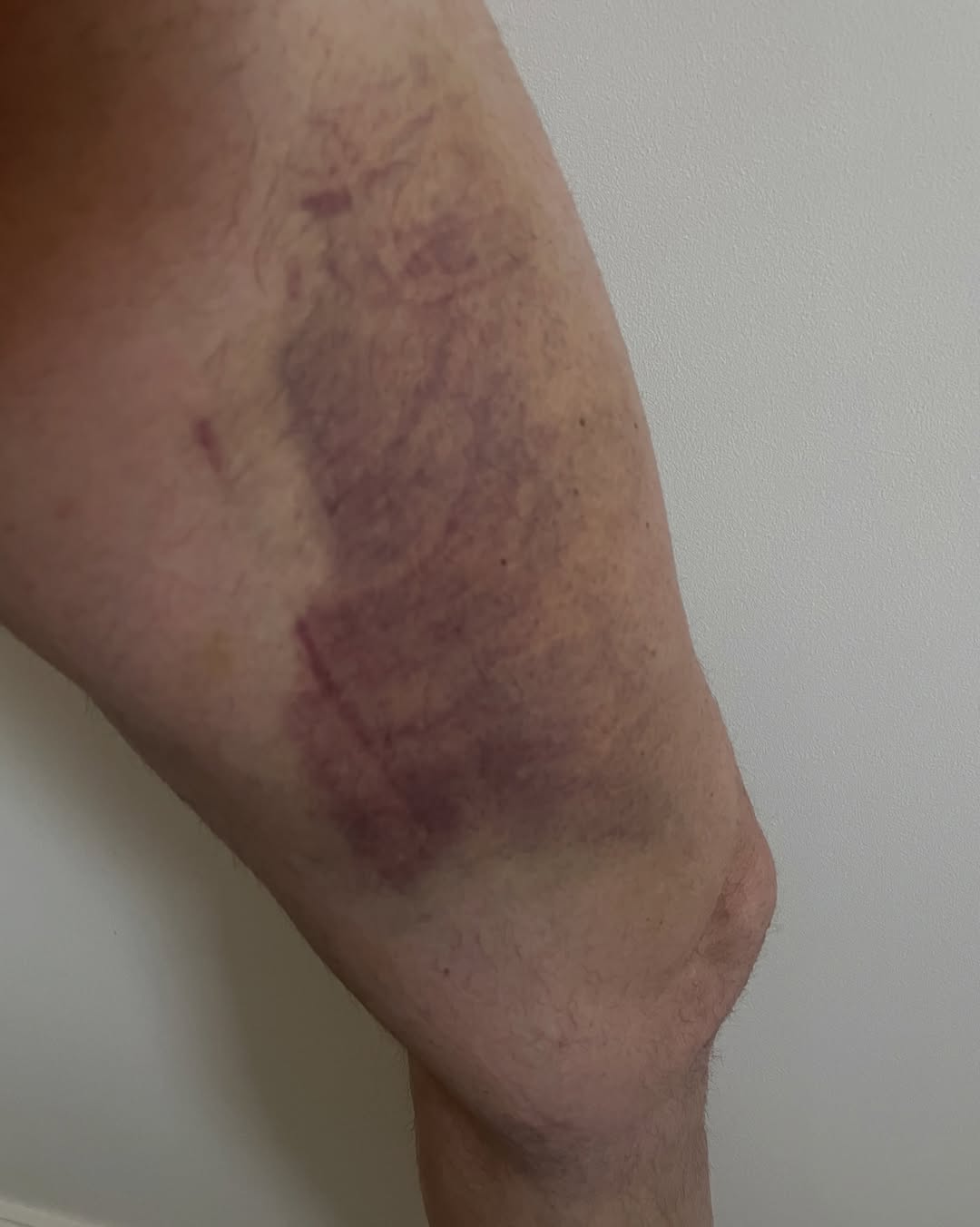 Fred Sirieix poses with his bruises on full display. | Source: Instagram/fred_sirieix