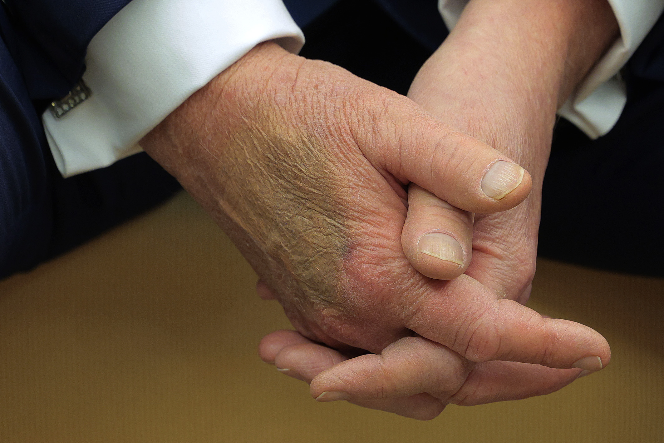 Makeup covers a bruise on the back of Donald Trump's hand as he hosts Emmanuel Macron for meetings at the White House. | Source: Getty Images