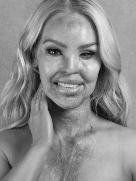 Katie Piper smiling directly at the camera, the scarring on her face and chest visible, in a black-and-white portrait shot dated 30 September 2025. | Source: Facebook/Katie Piper